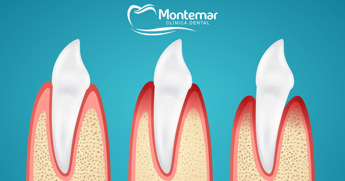 enfermedad periodontal