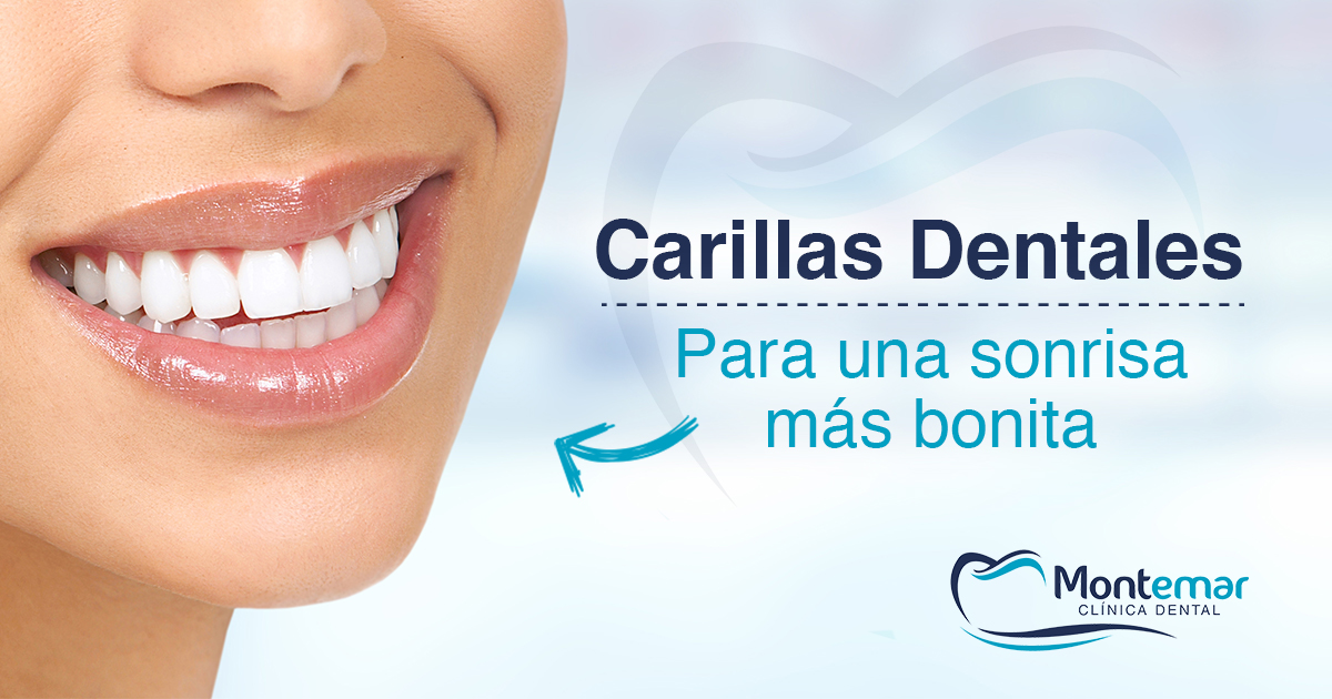 Carillas dentales. Elimine las imperfecciones de su sonrisa