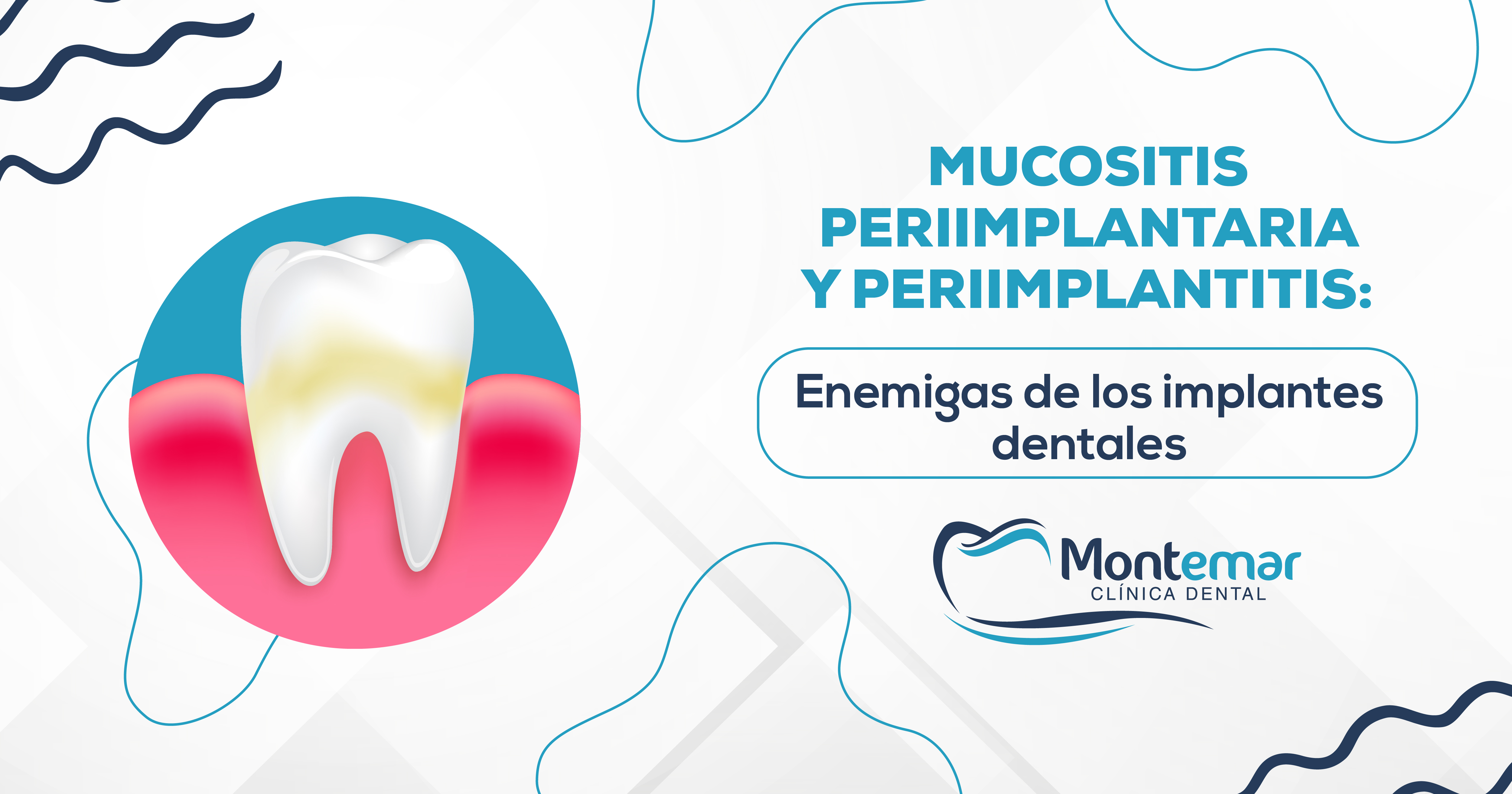 Mucositis periimplantaria y periimplantitis