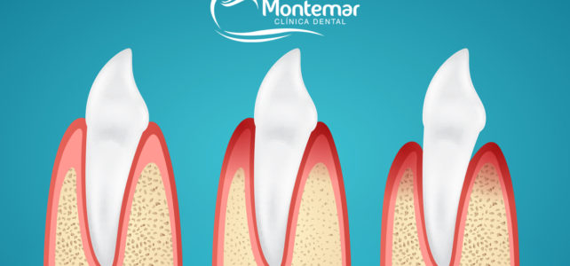 La enfermedad de las encías o enfermedad periodontal