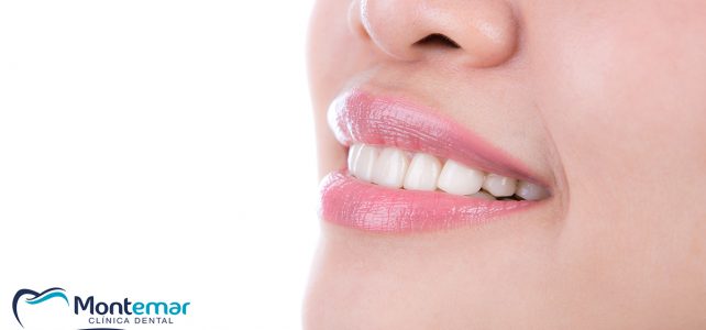 Invisalign, el secreto para lucir una sonrisa perfecta