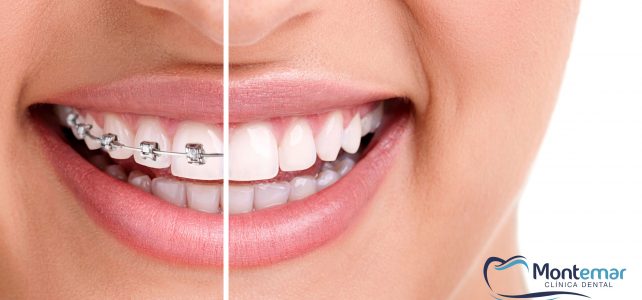 La salud bucodental cuando se usa ortodoncia estética