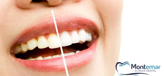 Blanqueamiento dental. Mitos y realidades.