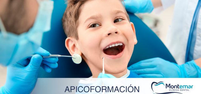 Apicoformación. Tratamiento bucodental para dientes inmaduros.