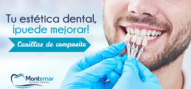 Carillas de composite: el tratamiento de estética dental que mejora tu sonrisa