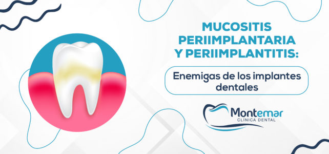 Mucositis periimplantaria y periimplantitis: enemigas de los implantes dentales